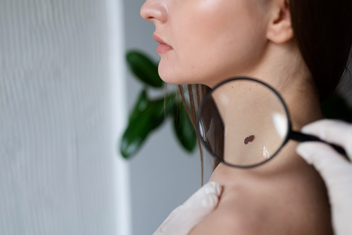 Skin cancer is the fourth most common cancer in the UAE: What you need to know